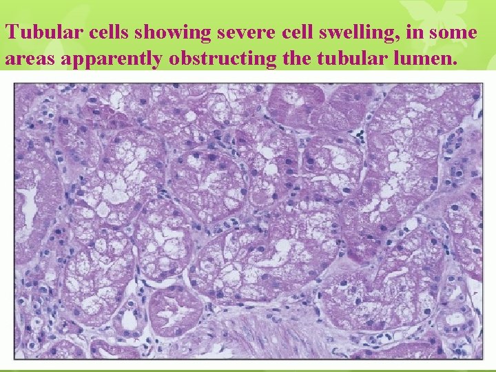 Tubular cells showing severe cell swelling, in some areas apparently obstructing the tubular lumen.