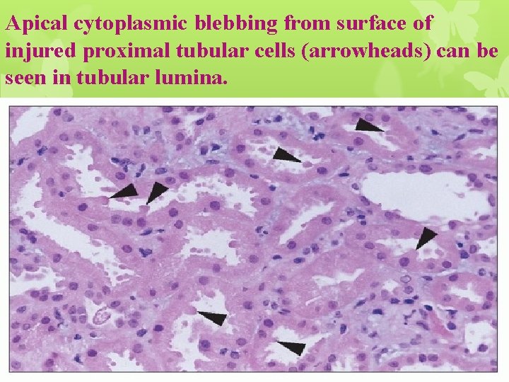 Apical cytoplasmic blebbing from surface of injured proximal tubular cells (arrowheads) can be seen