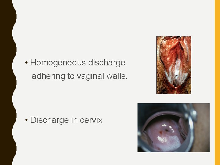  • Homogeneous discharge adhering to vaginal walls. • Discharge in cervix 