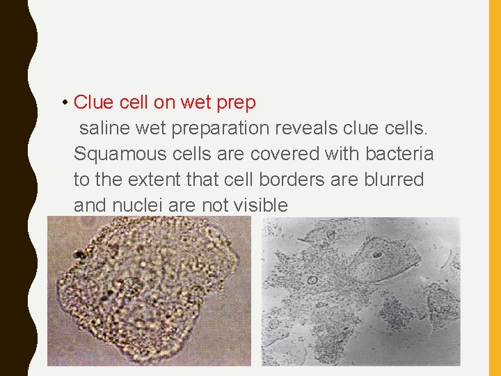  • Clue cell on wet prep saline wet preparation reveals clue cells. Squamous