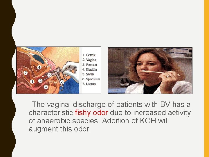  • Whiff test The vaginal discharge of patients with BV has a characteristic