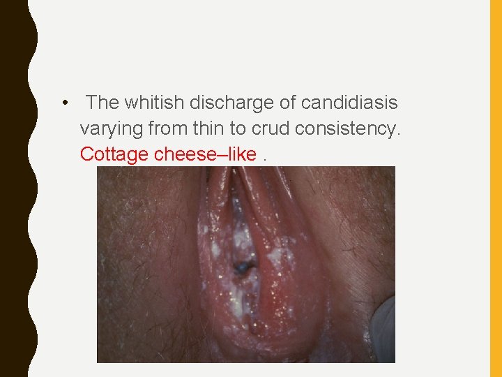  • The whitish discharge of candidiasis varying from thin to crud consistency. Cottage