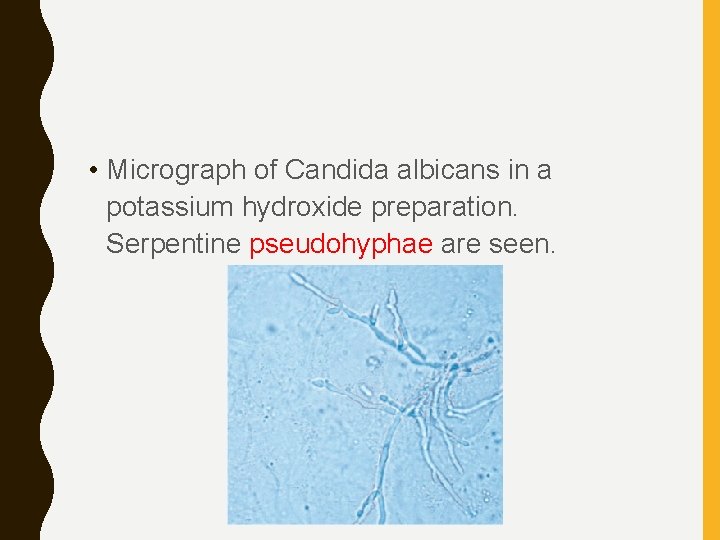  • Micrograph of Candida albicans in a potassium hydroxide preparation. Serpentine pseudohyphae are