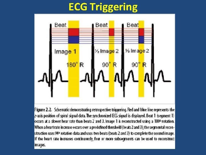 ECG Triggering 