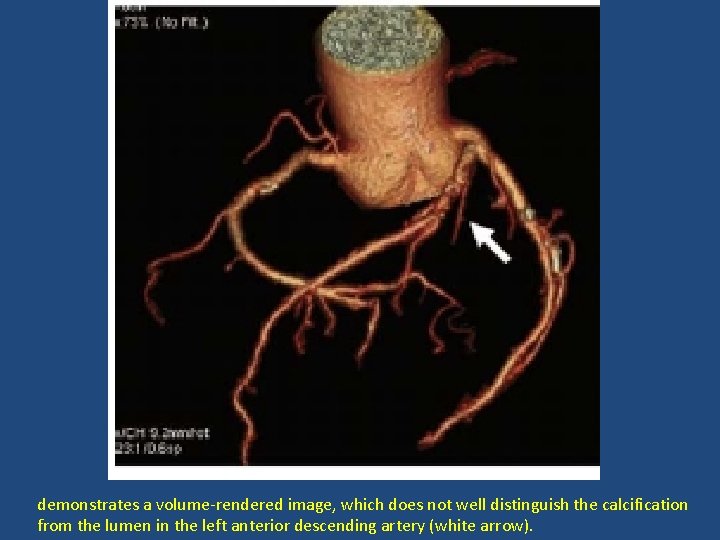 demonstrates a volume-rendered image, which does not well distinguish the calcification from the lumen