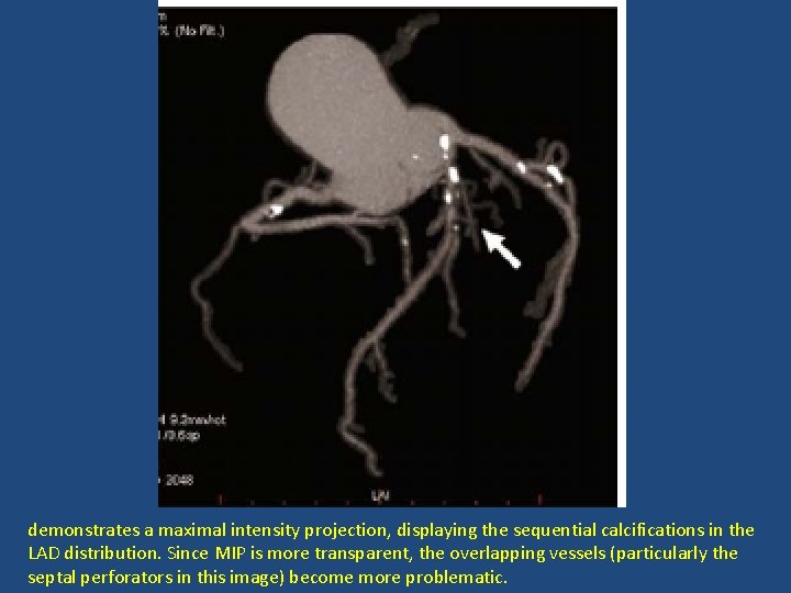 demonstrates a maximal intensity projection, displaying the sequential calcifications in the LAD distribution. Since