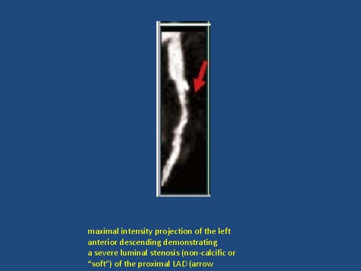 maximal intensity projection of the left anterior descending demonstrating a severe luminal stenosis (non-calcific