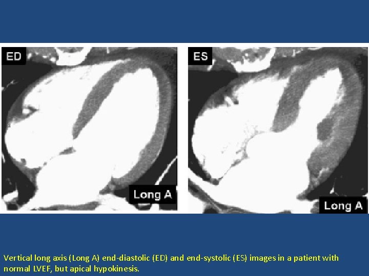 Vertical long axis (Long A) end-diastolic (ED) and end-systolic (ES) images in a patient