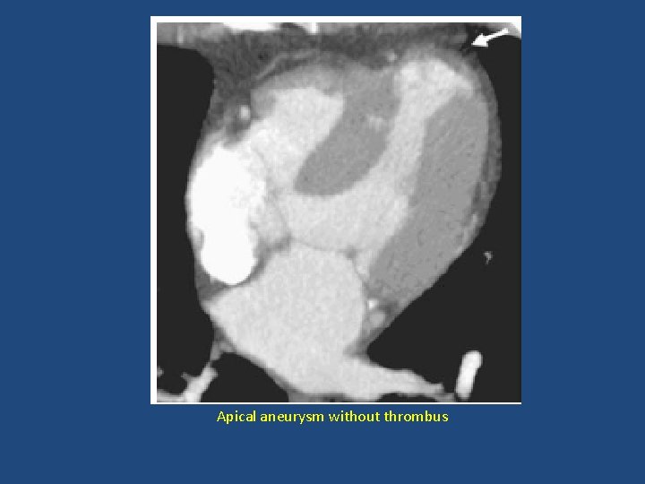 Apical aneurysm without thrombus 