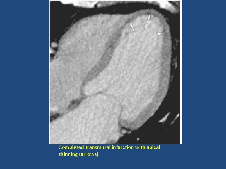 Completed transmural infarction with apical thinning (arrows) 