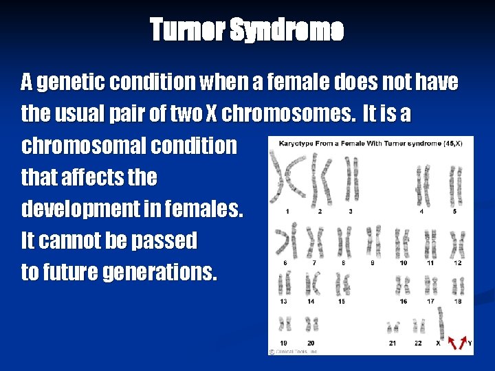 Turner Syndrome A genetic condition when a female does not have the usual pair