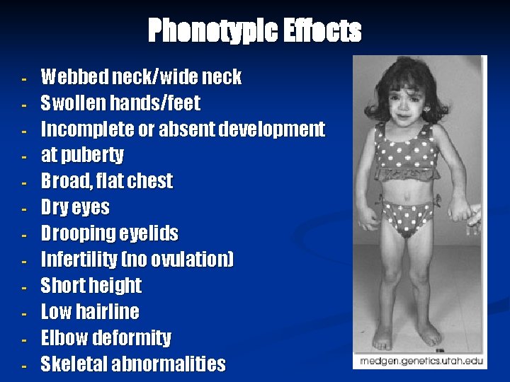 Phenotypic Effects - Webbed neck/wide neck Swollen hands/feet Incomplete or absent development at puberty