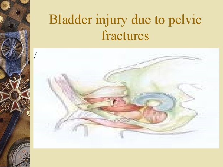 Bladder injury due to pelvic fractures / 
