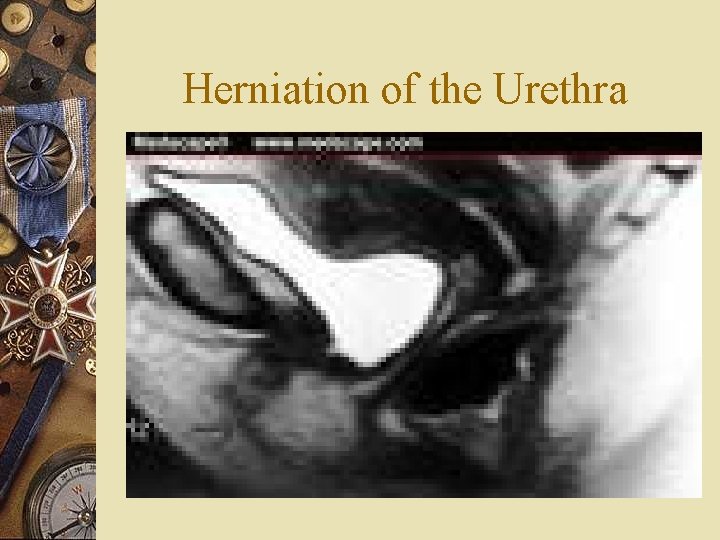 Herniation of the Urethra 