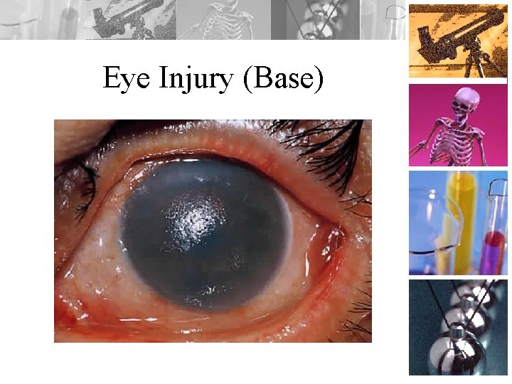 Eye Injury (Base) 