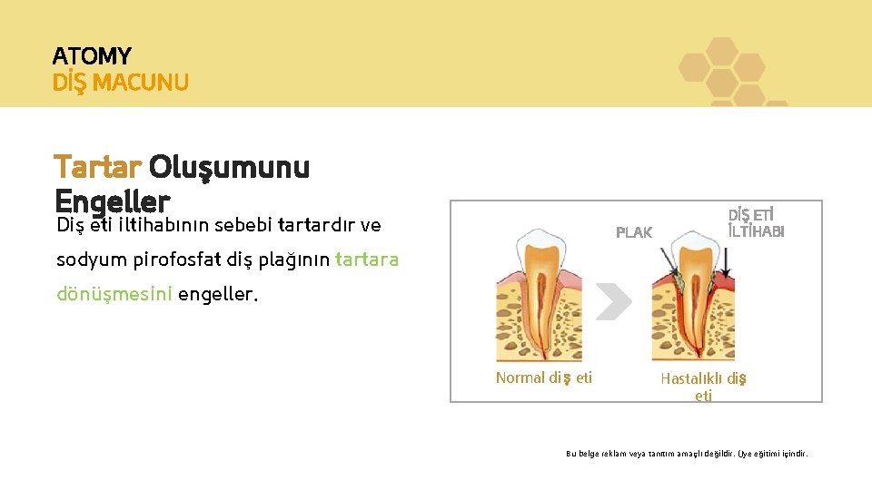 ATOMY DİŞ MACUNU Tartar Oluşumunu Engeller Diş eti iltihabının sebebi tartardır ve PLAK DİŞ