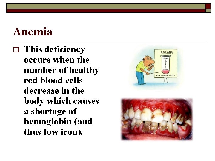 Anemia o This deficiency occurs when the number of healthy red blood cells decrease