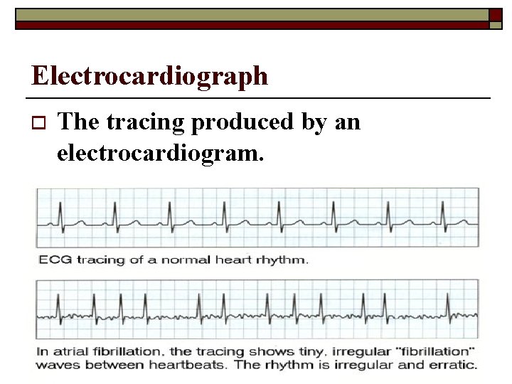 Electrocardiograph o The tracing produced by an electrocardiogram. 