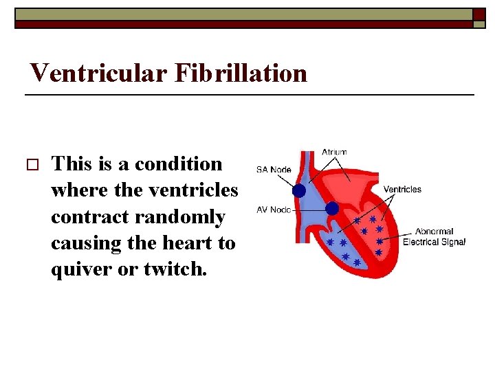 Ventricular Fibrillation o This is a condition where the ventricles contract randomly causing the