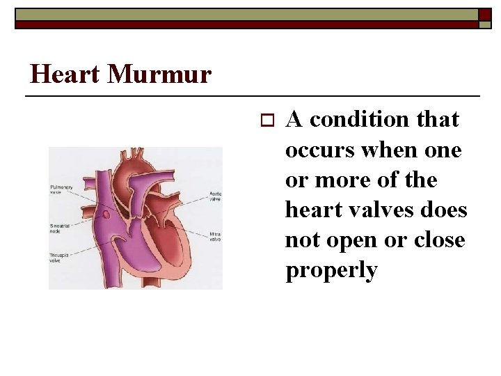 Heart Murmur o A condition that occurs when one or more of the heart