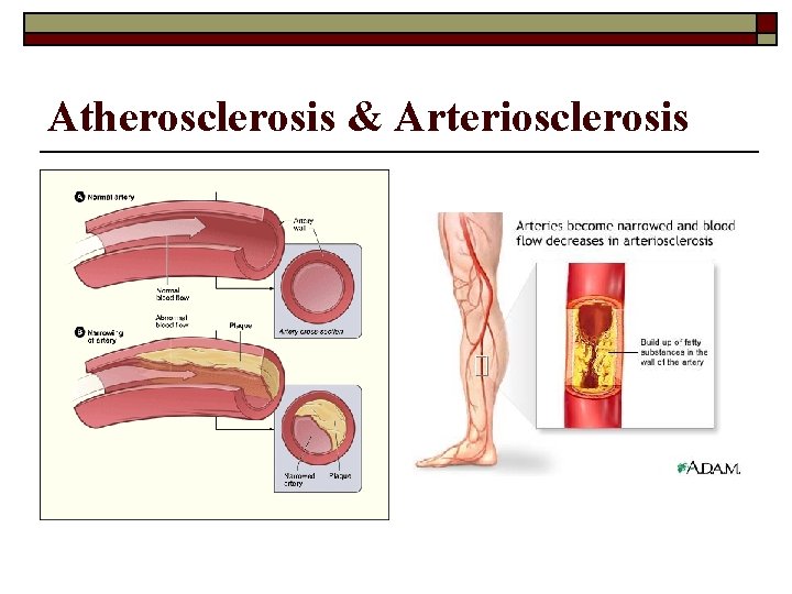 Atherosclerosis & Arteriosclerosis 