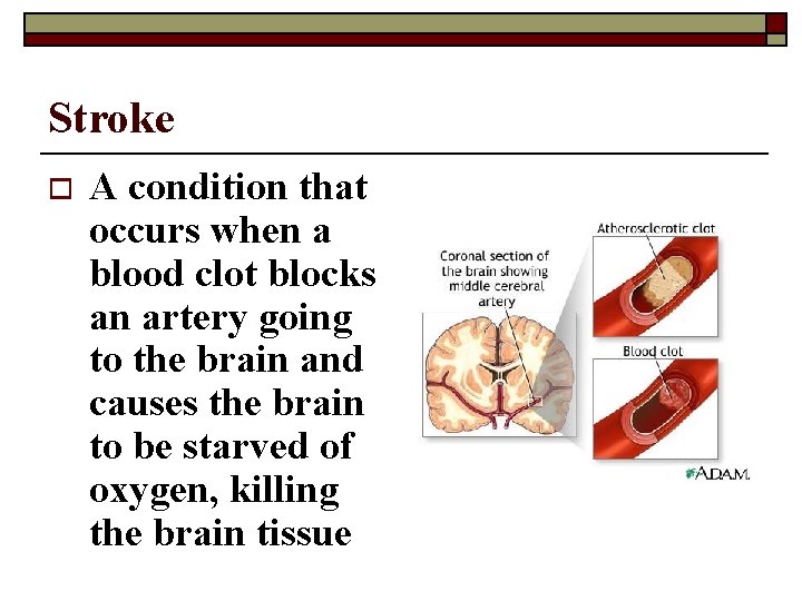 Stroke o A condition that occurs when a blood clot blocks an artery going