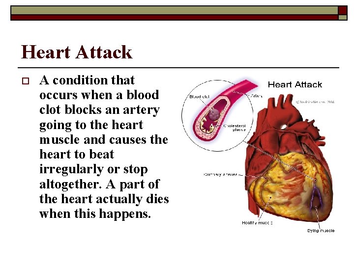 Heart Attack o A condition that occurs when a blood clot blocks an artery