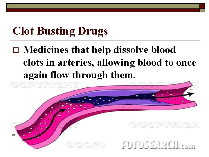 Clot Busting Drugs o Medicines that help dissolve blood clots in arteries, allowing blood