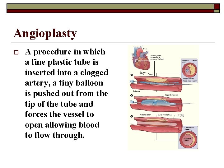 Angioplasty o A procedure in which a fine plastic tube is inserted into a