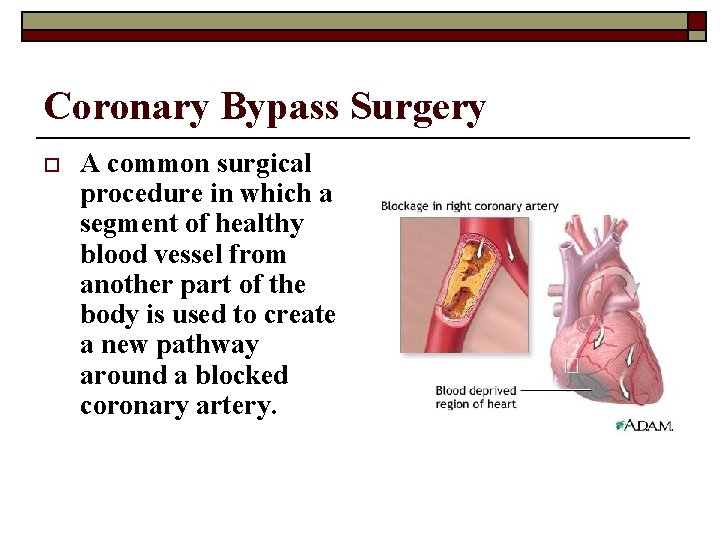 Coronary Bypass Surgery o A common surgical procedure in which a segment of healthy