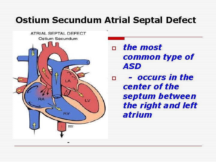 Ostium Secundum Atrial Septal Defect o o - the most common type of ASD Ostium Secundum Atrial Septal Defect o o - the most common type of ASD