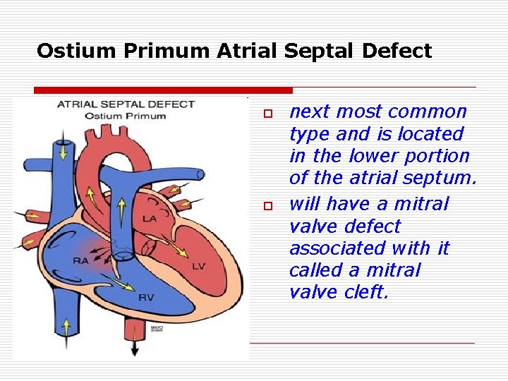 Ostium Primum Atrial Septal Defect o o next most common type and is located Ostium Primum Atrial Septal Defect o o next most common type and is located