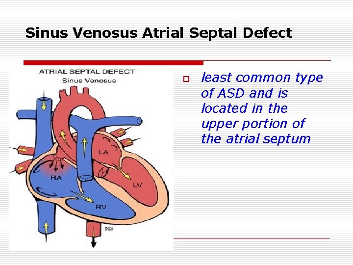 Sinus Venosus Atrial Septal Defect o least common type of ASD and is located Sinus Venosus Atrial Septal Defect o least common type of ASD and is located