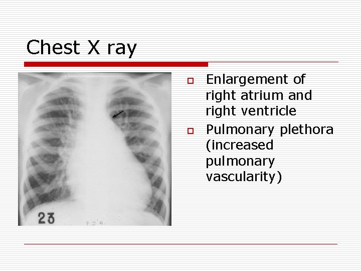 Chest X ray o o Enlargement of right atrium and right ventricle Pulmonary plethora Chest X ray o o Enlargement of right atrium and right ventricle Pulmonary plethora
