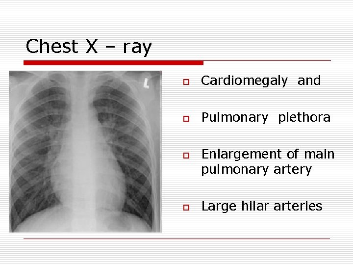 Chest X – ray o Cardiomegaly and o Pulmonary plethora o o Enlargement of