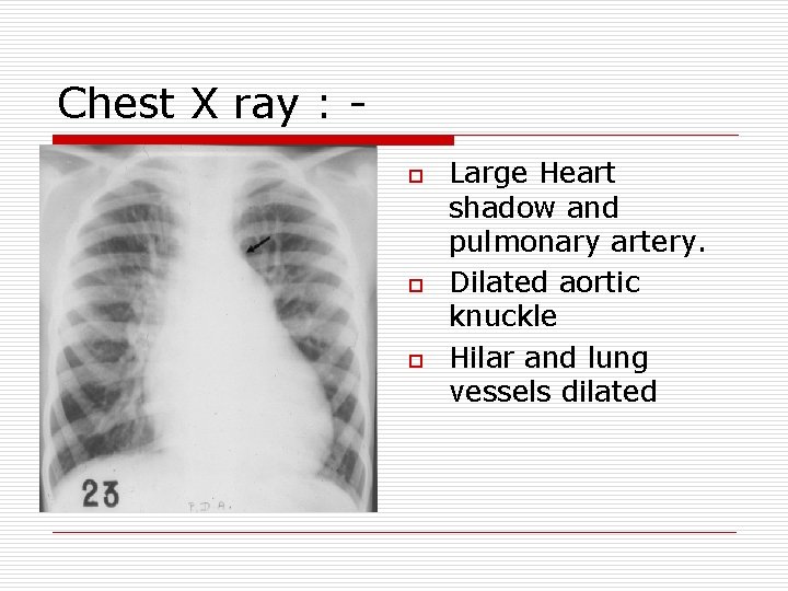 Chest X ray : o o o Large Heart shadow and pulmonary artery. Dilated Chest X ray : o o o Large Heart shadow and pulmonary artery. Dilated