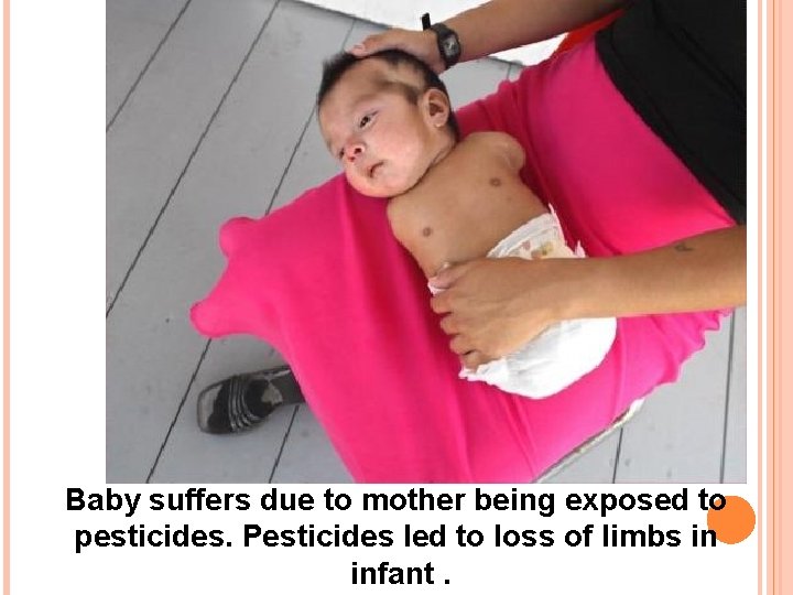 Baby suffers due to mother being exposed to pesticides. Pesticides led to loss of