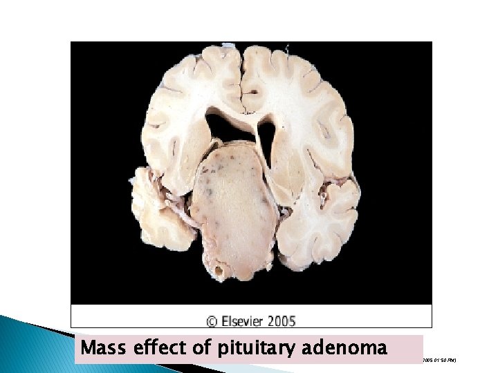 Mass effect of pituitary adenoma Downloaded from: Robbins & Cotran Pathologic Basis of Disease
