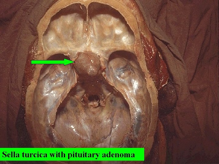 Sella turcica with pituitary adenoma 