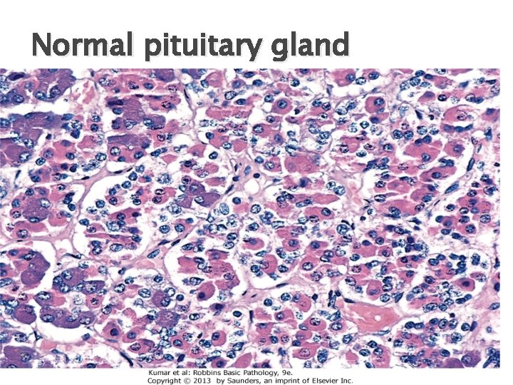 Normal pituitary gland 