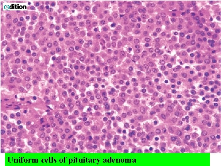 Uniform cells of pituitary adenoma Downloaded from: Robbins & Cotran Pathologic Basis of Disease
