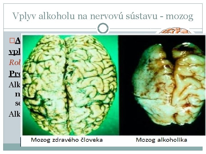 Vplyv alkoholu na nervovú sústavu - mozog �Ako sa správajú mladí ľudia pod vplyvom