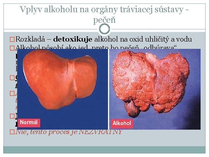 Vplyv alkoholu na orgány tráviacej sústavy pečeň �Rozkladá – detoxikuje alkohol na oxid uhličitý