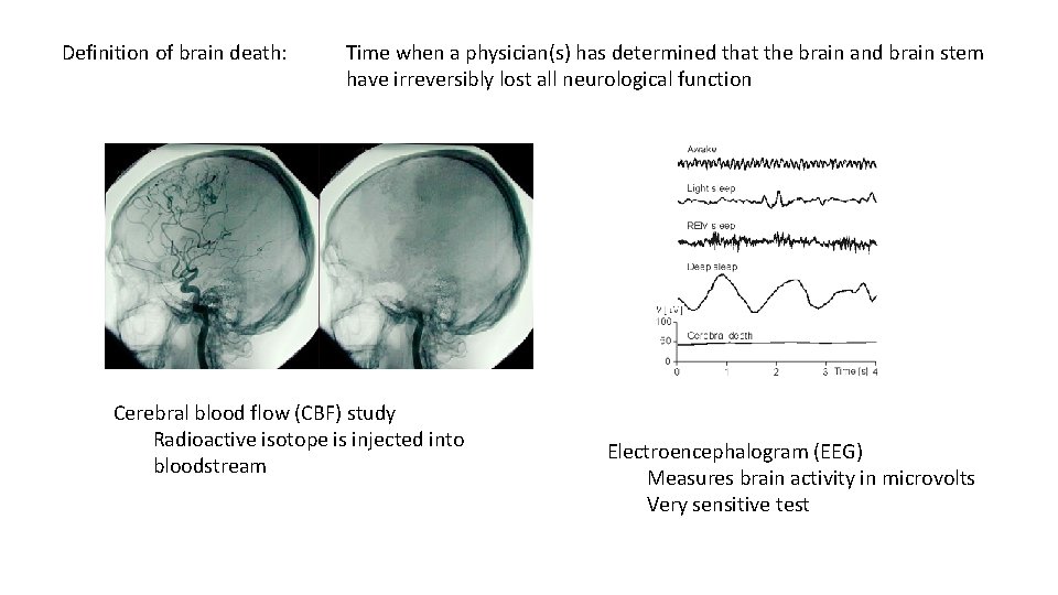 Definition of brain death: Time when a physician(s) has determined that the brain and