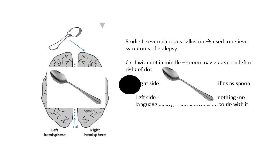 Studied severed corpus callosum used to relieve symptoms of epilepsy Card with dot in