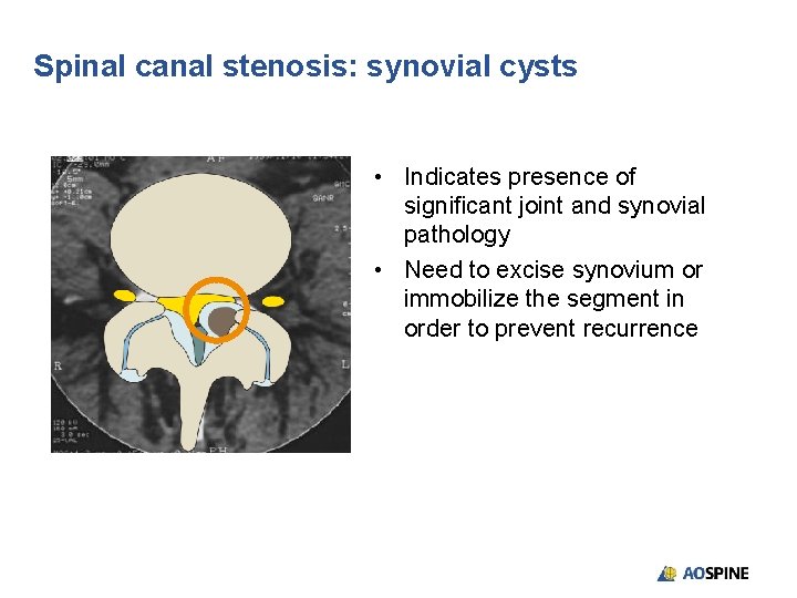 Spinal canal stenosis: synovial cysts • Indicates presence of significant joint and synovial pathology