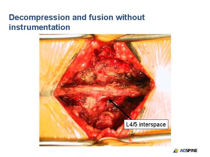 Decompression and fusion without instrumentation L 4/5 interspace 