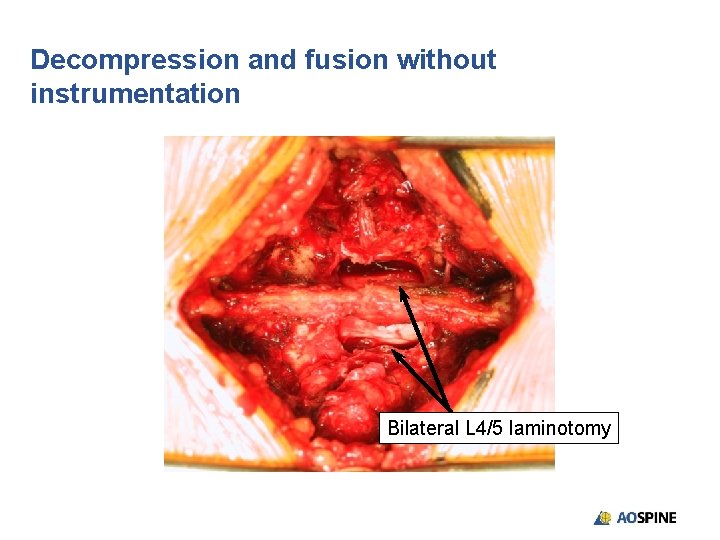 Decompression and fusion without instrumentation Bilateral L 4/5 laminotomy 