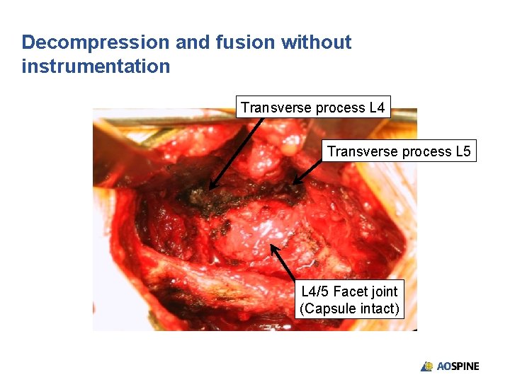 Decompression and fusion without instrumentation Transverse process L 4 Transverse process L 5 L