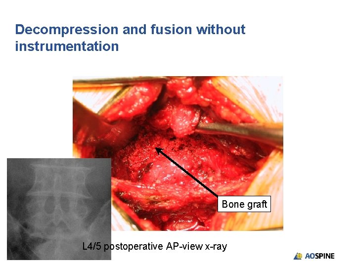 Decompression and fusion without instrumentation Bone graft L 4/5 postoperative AP-view x-ray 